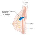 المرحلة 3B من سرطان الثدي.
