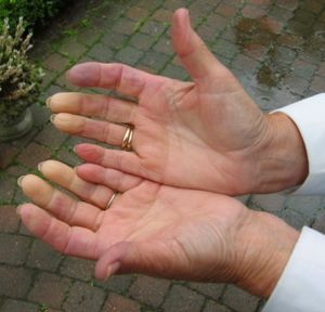 Raynaud-hand2.jpg