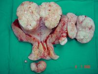Large Fibroid; Panhysterectomy.jpg