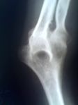 Pathological fusion of three bones at elbow.