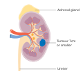 Stage 1 kidney cancer