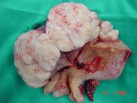 Large polyp, Multiple fibroids; Panhysterectomy.jpg