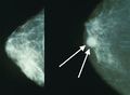 تصوير الثدي يظهر ثدياً طبيعياً (اليسار) وثدياً مصاب بالسرطان (اليمين).