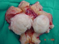 Fibroid; Total Hysterectomy.jpg