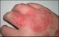 Acute dermatitis